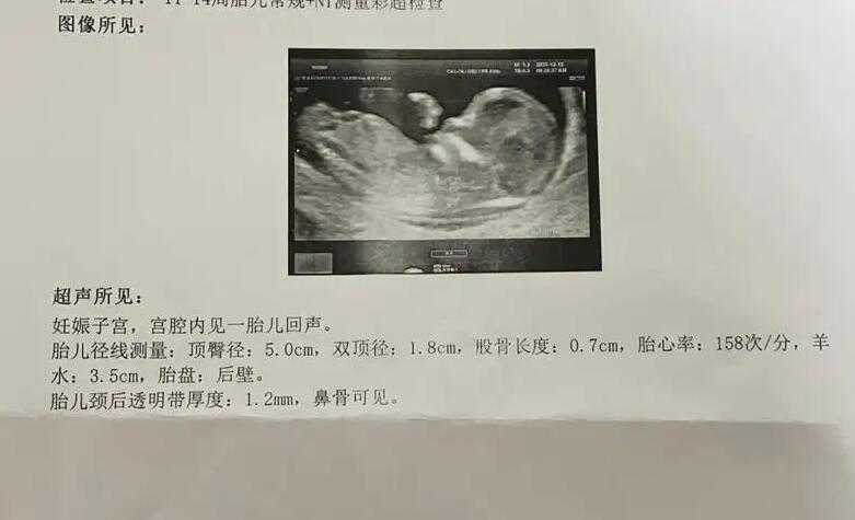 武汉正规的捐卵 哪些情况下可以做武汉试管婴儿? ‘孕妇四维怎么看男女小窍诀